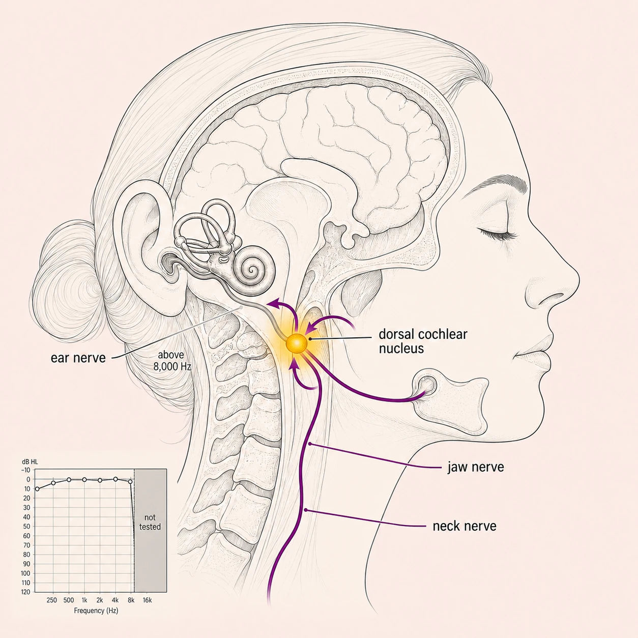Volume control turned up too far at the dorsal cochlear nucleus